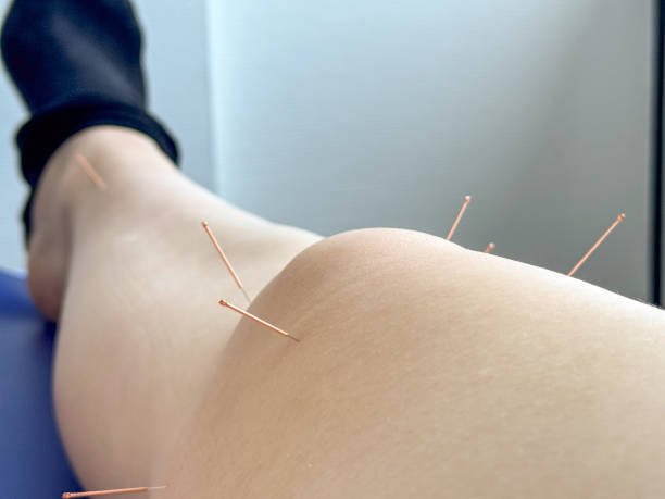 istock Acupuncture needles in a swollen knee 2200621352