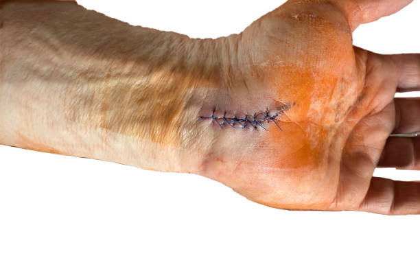 istock Wound suture body surgery operation bandage 2200662511
