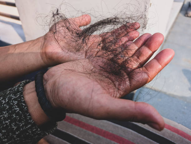 istock Fallen Hair After Combing in Men, India 2200794699
