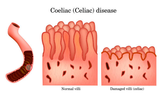 istock Coeliac Disease Intestinal Damage Illustration. Celiac Disease Digestive System Infographic. Normal vs Damaged Villi in Celiac Disease. 2200858834
