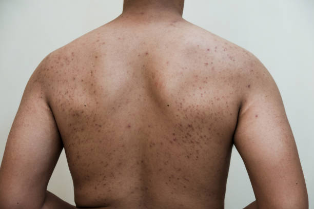 istock A rash of red dots and blisters or acne on a man's back in white background 2200910894