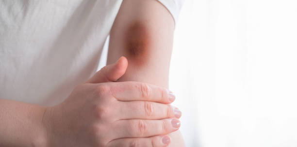 istock A woman's hand with hematomas after a strong impact, healing process. Bruises on the hand after injury due to soft tissue damage. 2200930074