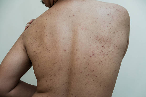 istock A rash of red dots and blisters or acne on a man's back in white background, 2201138962