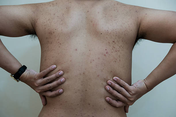 istock A rash of red dots and blisters or acne on a man's back in white background, 2201138968