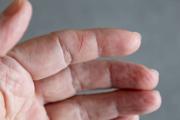 istock close-up of a finger with a small cut 2201325046
