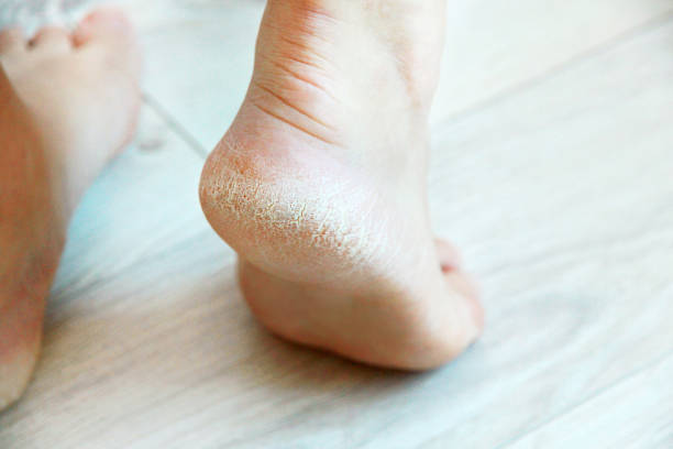 istock Close Showing Cracks Wound On Heels Stock Photo 2201470718