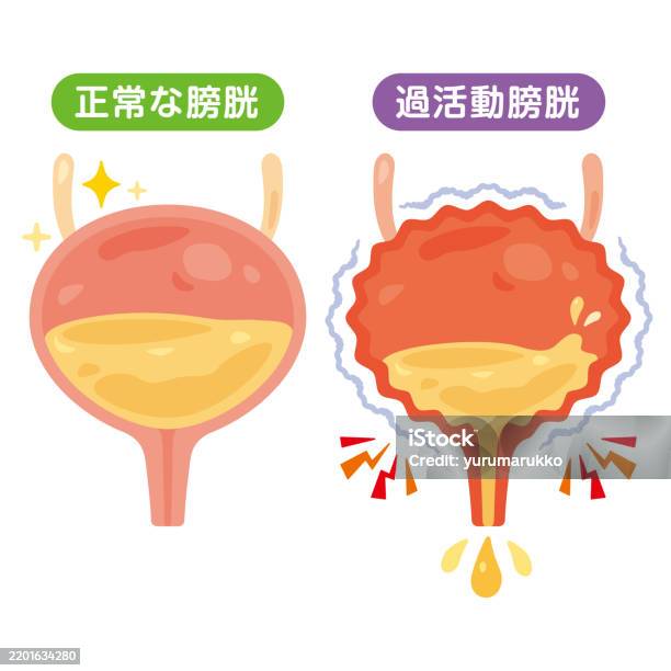 Gross Normal Bladder Illustration Of A Normal Bladder And An Overactive Bladder Stock ...