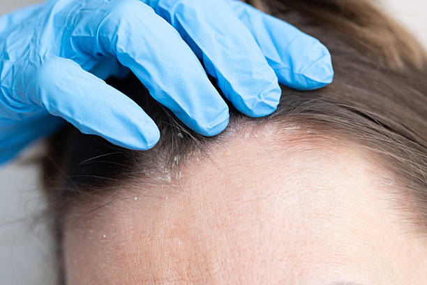 istock An appointment with a dermatologist. Woman has dermatitis on her scalp. 2201721453