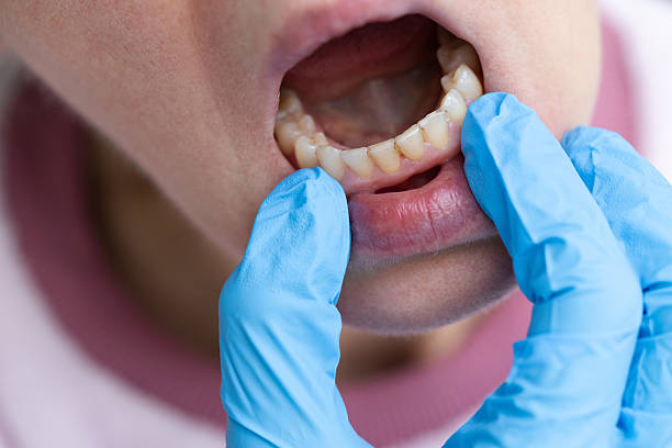 istock Dentist examining teeth with dental calculus and plaque. 2201721623