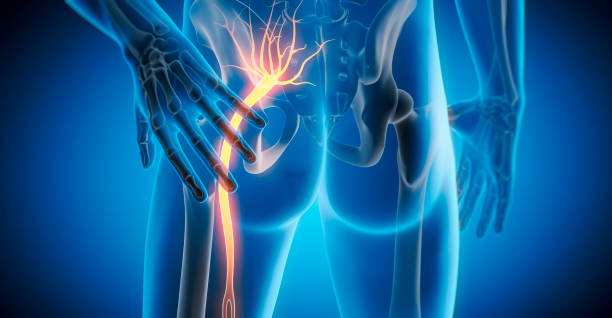 istock Sciatica- nerve pain injury or irritation sciatic nerve 2201740792