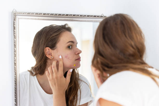 istock Young woman looking at her acne in the mirror 2201954835
