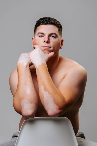 istock Male model with vitiligo showcases confidence and individuality in studio 2202042263