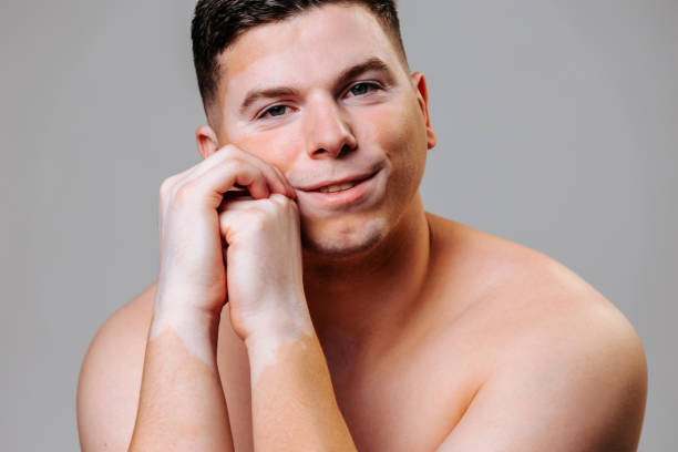 Young man with vitiligo smiles for a portrait in a studio setting