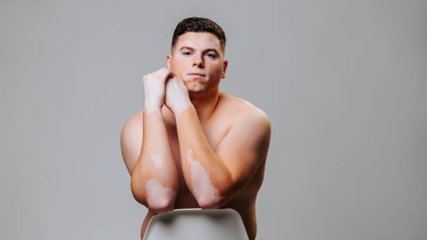 istock Vitiligo man poses creatively showcasing skin condition in studio setting 2202042272