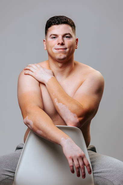 istock Male model with vitiligo poses confidently in a studio setting 2202042273