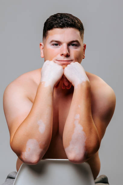 Male with vitiligo poses confidently while embracing his unique skin condition
