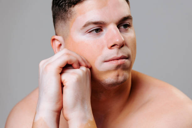 istock Male with vitiligo shows skin condition in a studio setting 2202042285