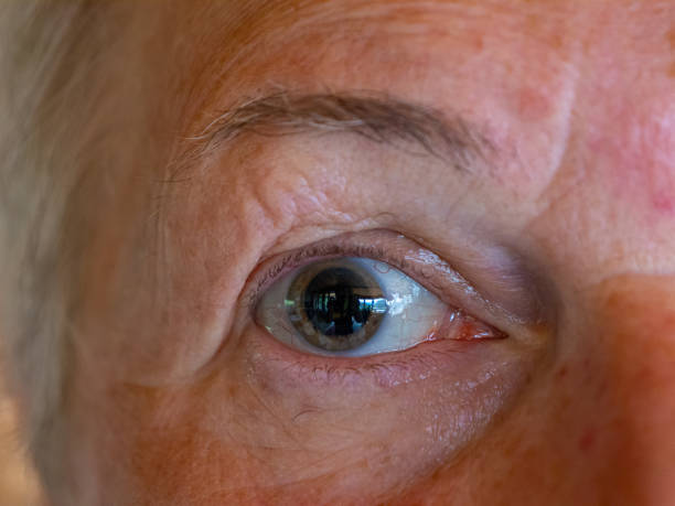 istock CLOSE UP, PORTRAIT: Greatly enlarged eye pupil after visiting ophthalmologist 2202162315
