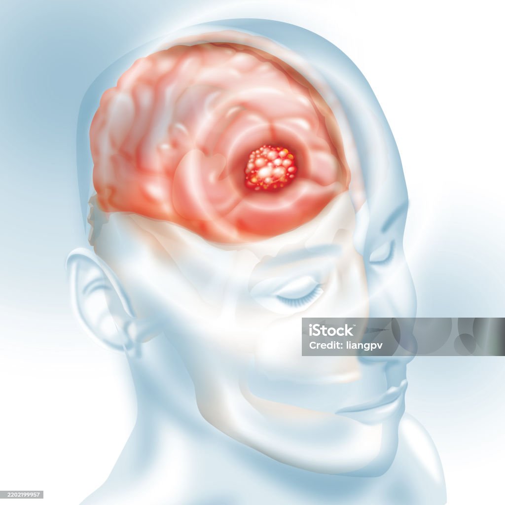Brain Cancer Vector Brain Cancer Stock Illustration - Download Image Now - Brain Tumour ...