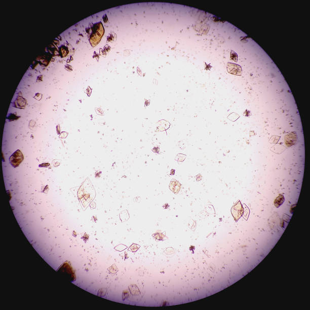 istock Uric Acid and Calcium oxalate, Urine Test Microscopic urinalysis. 2202286233