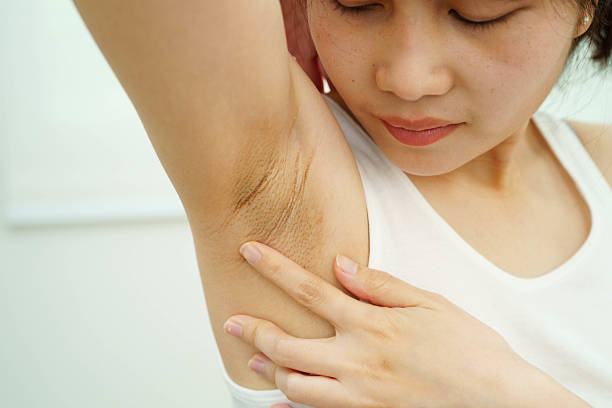 istock Asian woman have problem black armpit beauty skin care. 2202500264