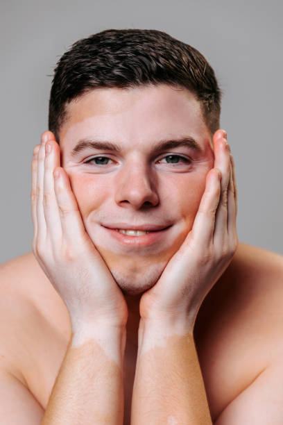 istock Male with vitiligo expressing confidence and positivity while posing 2202581298