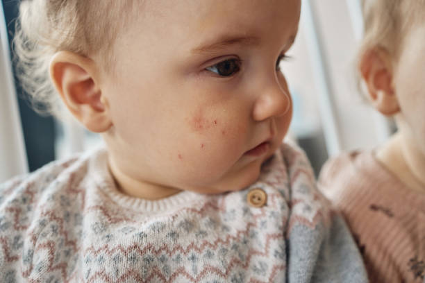 istock Baby girl with eczema 2202636320