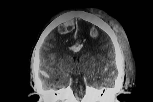 istock CAT Scan of severo skull brain trauma 2202685101