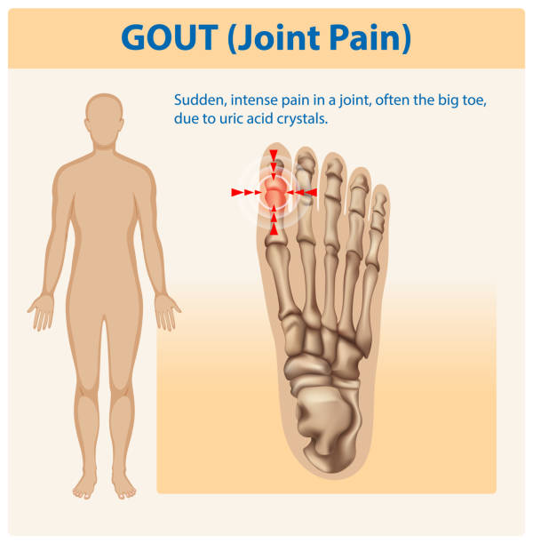 istock Illustration of gout affecting the big toe joint 2202950613