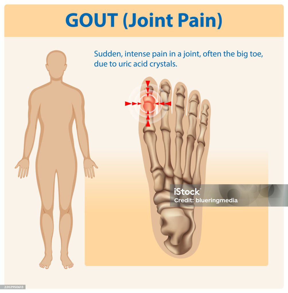 Mig Toe Illustration Of Gout Affecting The Big Toe Joint Stock Illustration ...