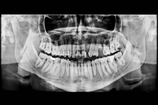 istock A lower wisdom tooth with roots displaying crossed and curved morphology 2203122275