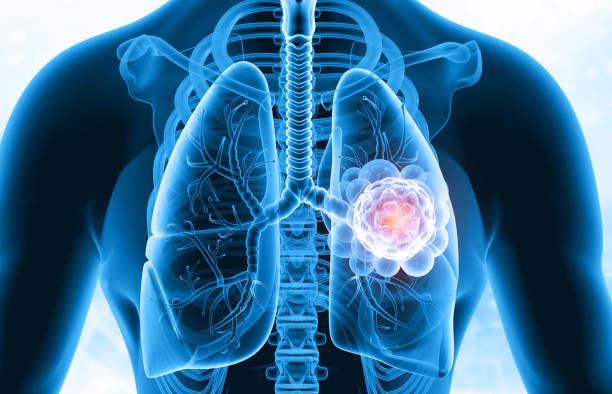 istock Lung's cancer, lungs infection 2203187196