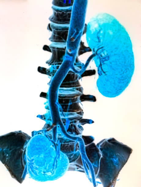 istock CT angiogram scan of the pelvis, likely a post-mortem scan revealing bladder over-distension and possible urinary tract issues. 2203208545