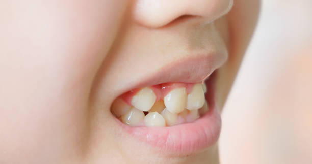 istock Child cavities and crooked teeth 2203380639