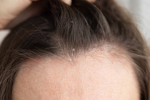 istock Closeup woman hair with dandruff. 2203608689