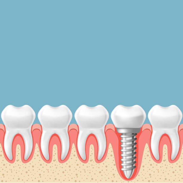 istock Row of teeth with dental implant - teeth prosthetics scheme, gum cut 2203794975