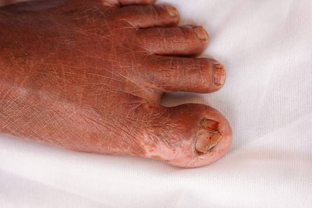 Bandaged Big Toe of an Elderly Woman – Injury Close-Up