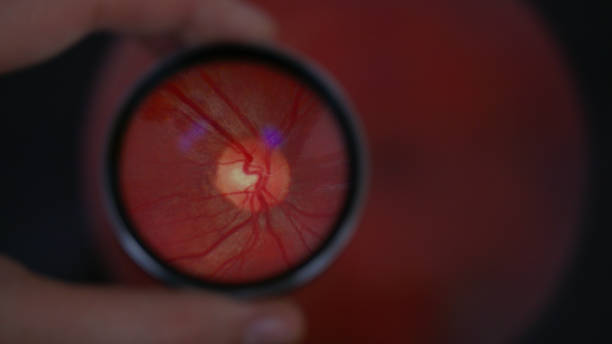 Examination of retina with 20 diopter lens. A fundus screening method during eye exam