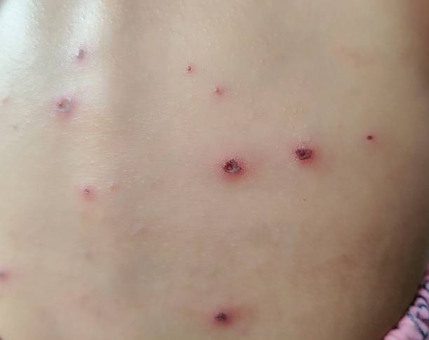 istock chicken pox disease in children 2203908979