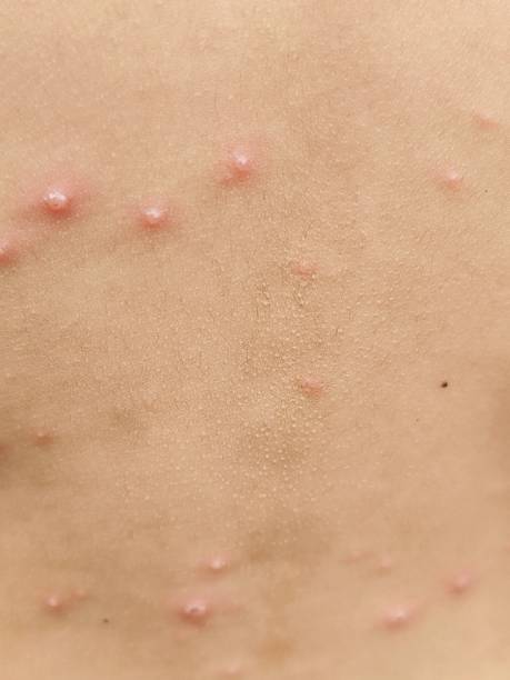 istock chicken pox disease in children 2203908999