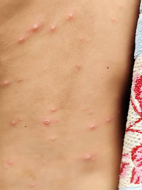istock chicken pox disease in children 2203909005