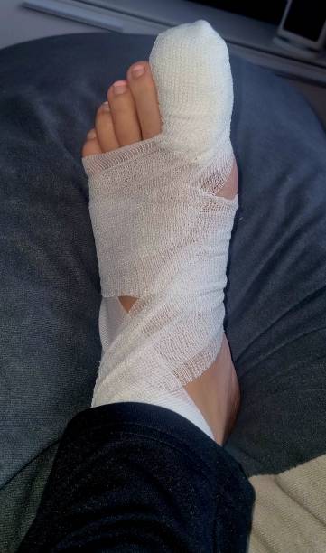 istock toe surgery, ingrown toenail 2204072950