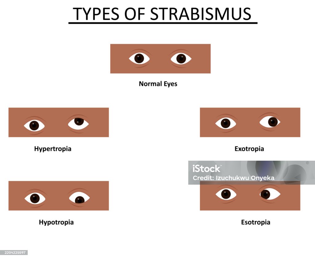 Types Of Strabismus Vector Illustration Stock Illustration - Download ...