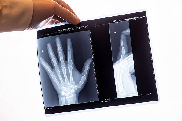 istock A gloved hand holds up a digital x-ray image of a hand showing two views 2204459659