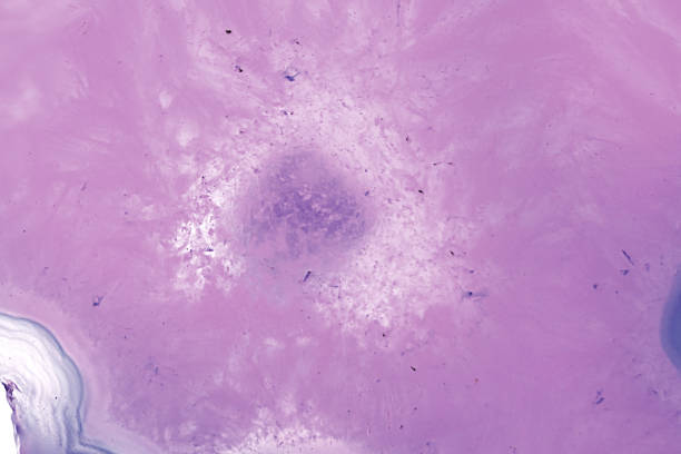 Mycobacterium tuberculosis positive (small red rod) in sputum smear, acid-fast stain, analyze by microscope
