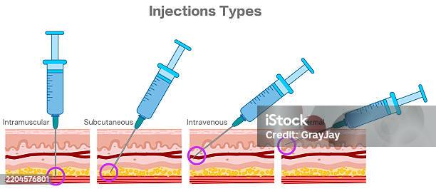 Neuf Il Injection Types Dangle Dinjection Injection Intramusculaire Intracutanée ...
