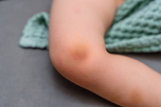 istock Bruise on the child's knee 2204587689
