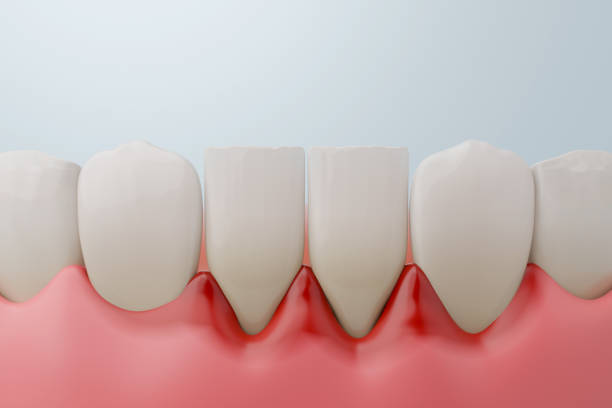 istock periodontitis and gum recession 2204657022