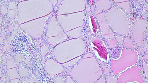 istock Micrograph showing histology of bilateral thyroid nodules under microscope with adenomatous goiter results in pathology laboratory. 2204682756