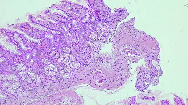 istock Human cell tissue under microscope in pathology laboratory. Microscopic picture of chronic gastric disease showing Helicobacter pylori bacterial infection, hematoxylin eosin staining 2204682758